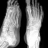 X-RAY of foot
