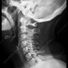 This lateral (from the side) x-ray of the cervical spine shows normal anatomy.