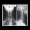 radiografie vertebrala cervicala